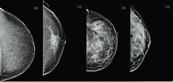 Mammogram images showing a range of breast densities, starting with a mostly fatty breast on the left, to a very dense breast on the right. Image courtesy GE Healthcare.